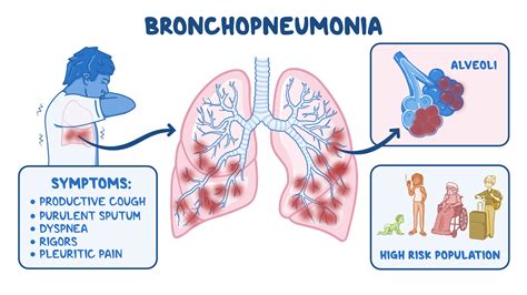 What Causes Bronchitis Pneumonia